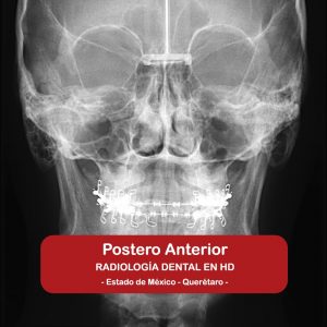Postero Anterior
