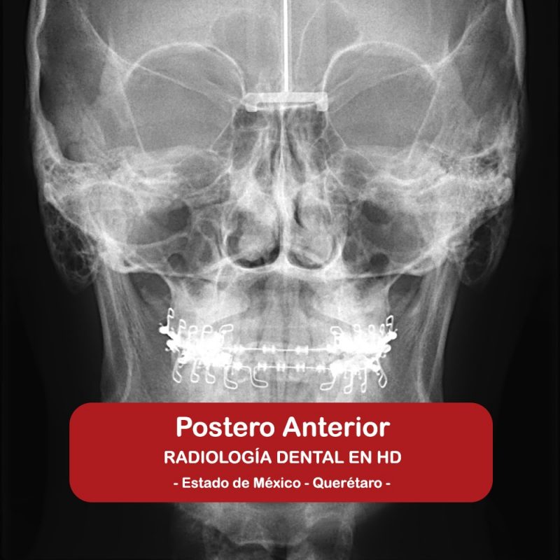 Postero Anterior