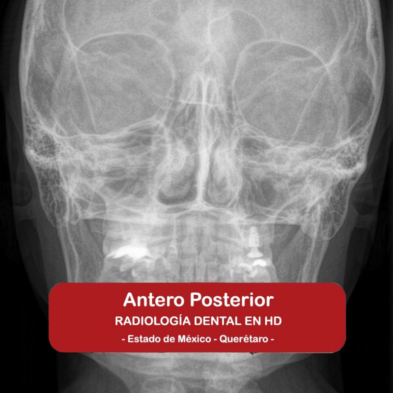 Antero Posterior