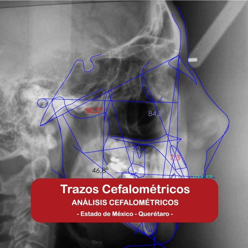 Trazos Cefalométricos