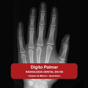 Dígito Palmar (Carpal)