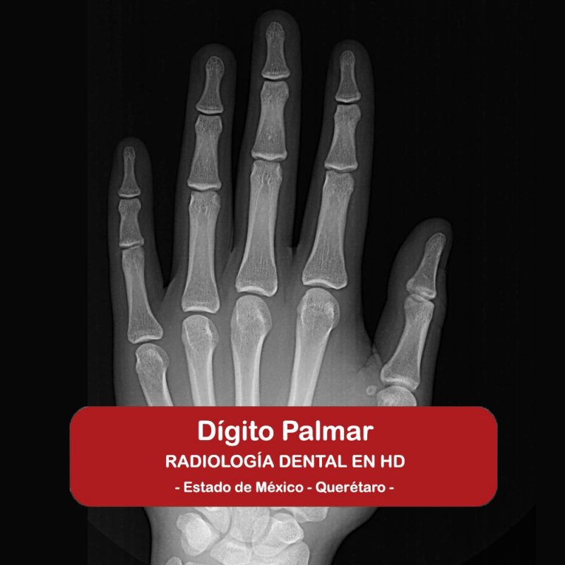 Dígito Palmar (Carpal)