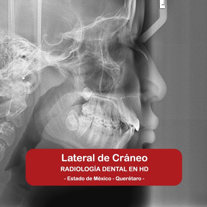 Lateral de Cráneo