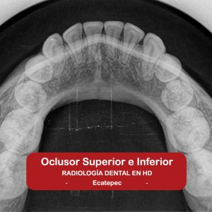 Oclusor Superior e Inferior