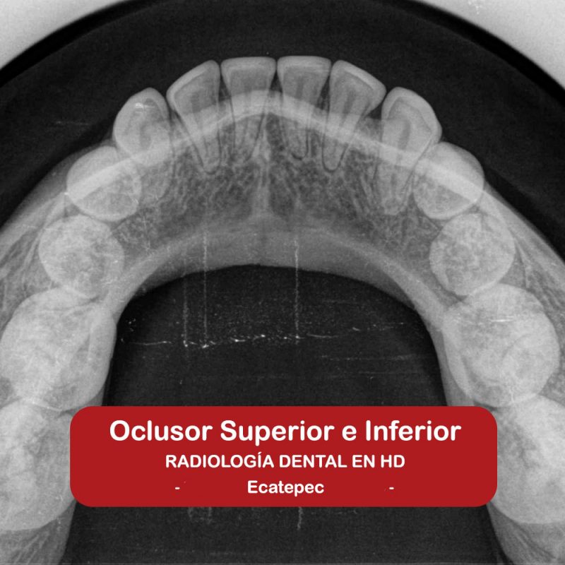 Oclusor Superior e Inferior