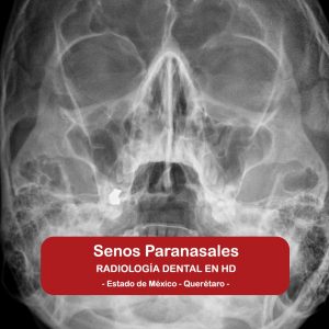 Senos Paranasales