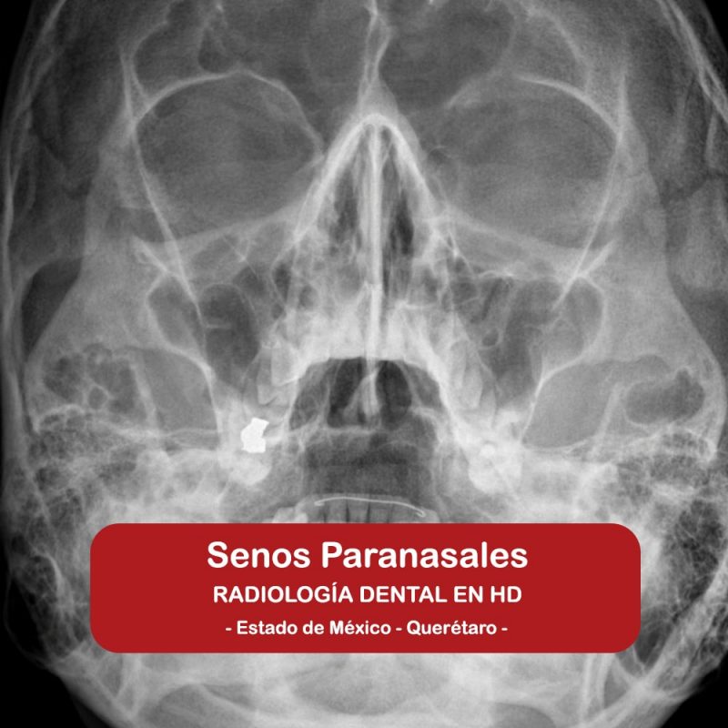 Senos Paranasales