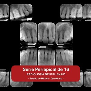 Serie Periapical de 16