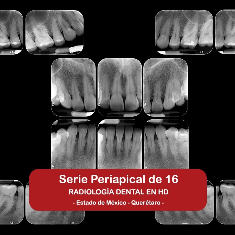 Serie Periapical de 16