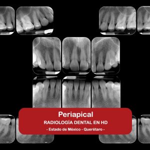 Periapical