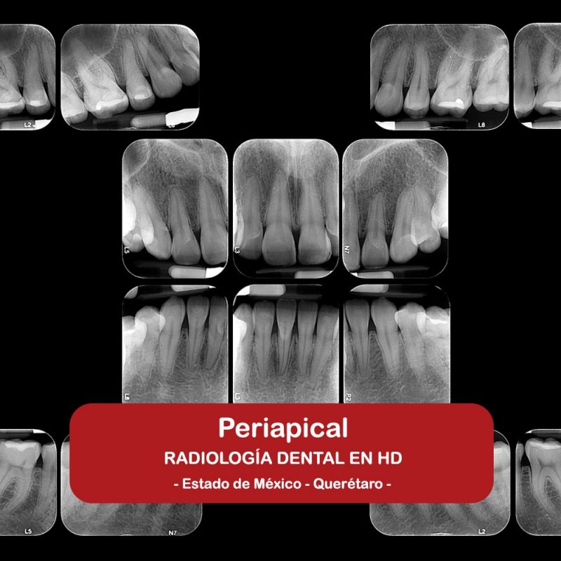 Periapical / Periapical Digital